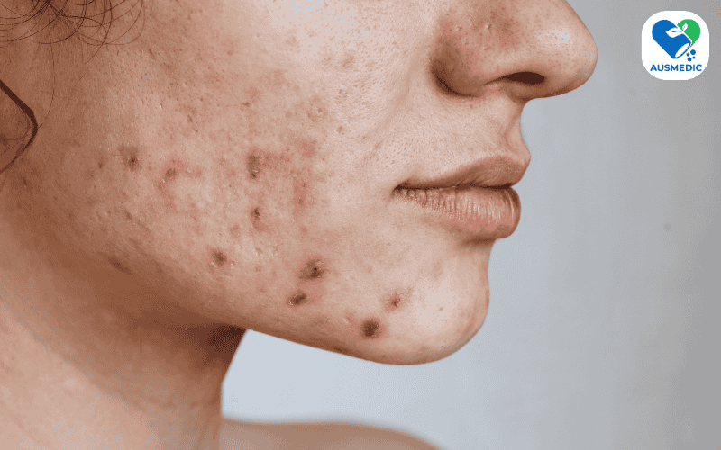 Tác hại của cà phê đối với làn da: Cảnh giác trước những rủi ro